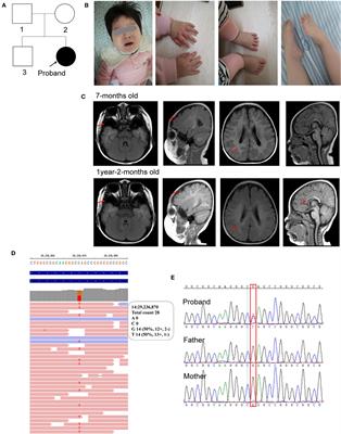 Identification of a de novo mutation of the FOXG1 gene and comprehensive analysis for molecular factors in Chinese FOXG1-related encephalopathies